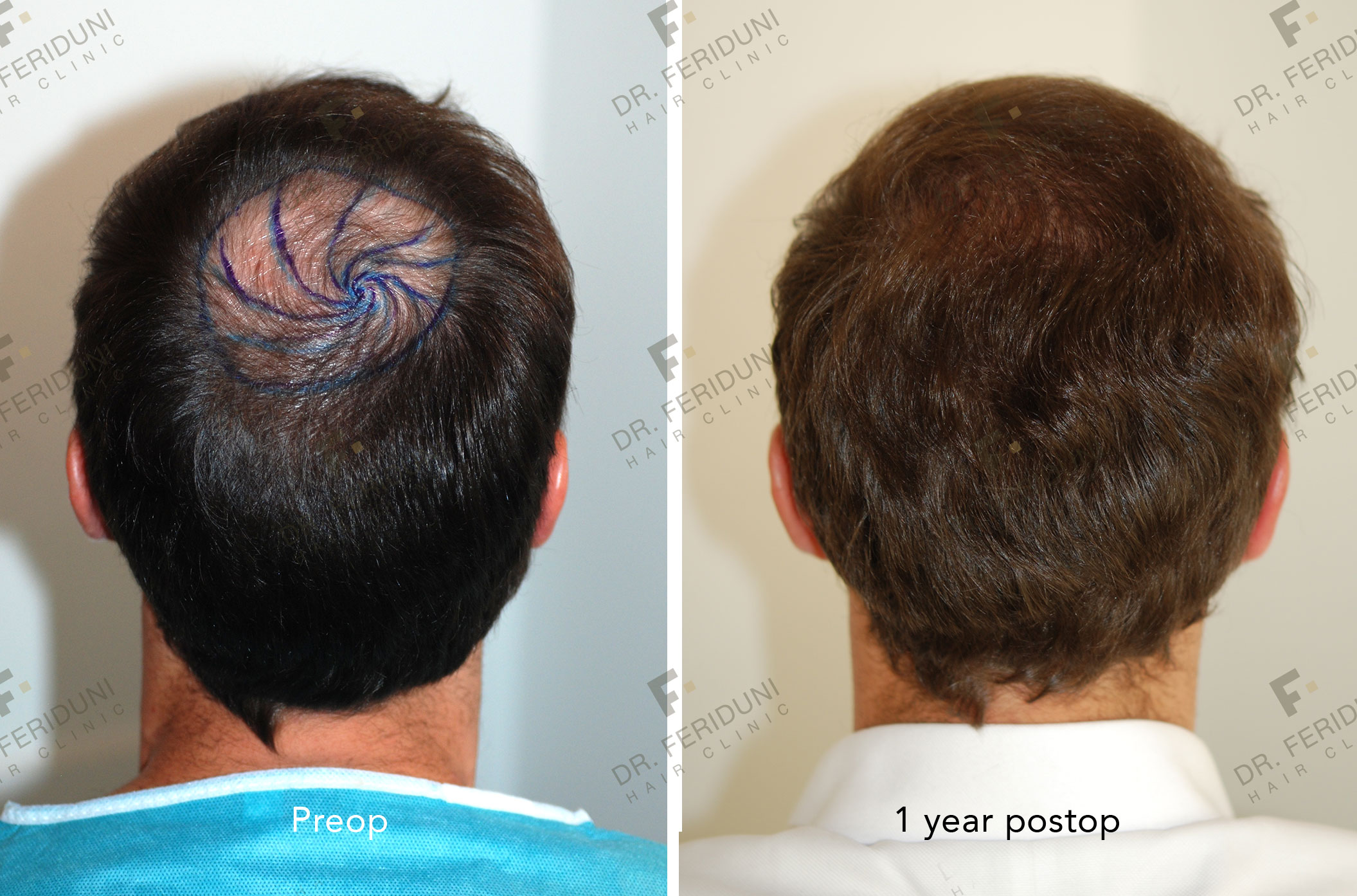 DS1 Trasplante de cabello - Dr. Feriduni