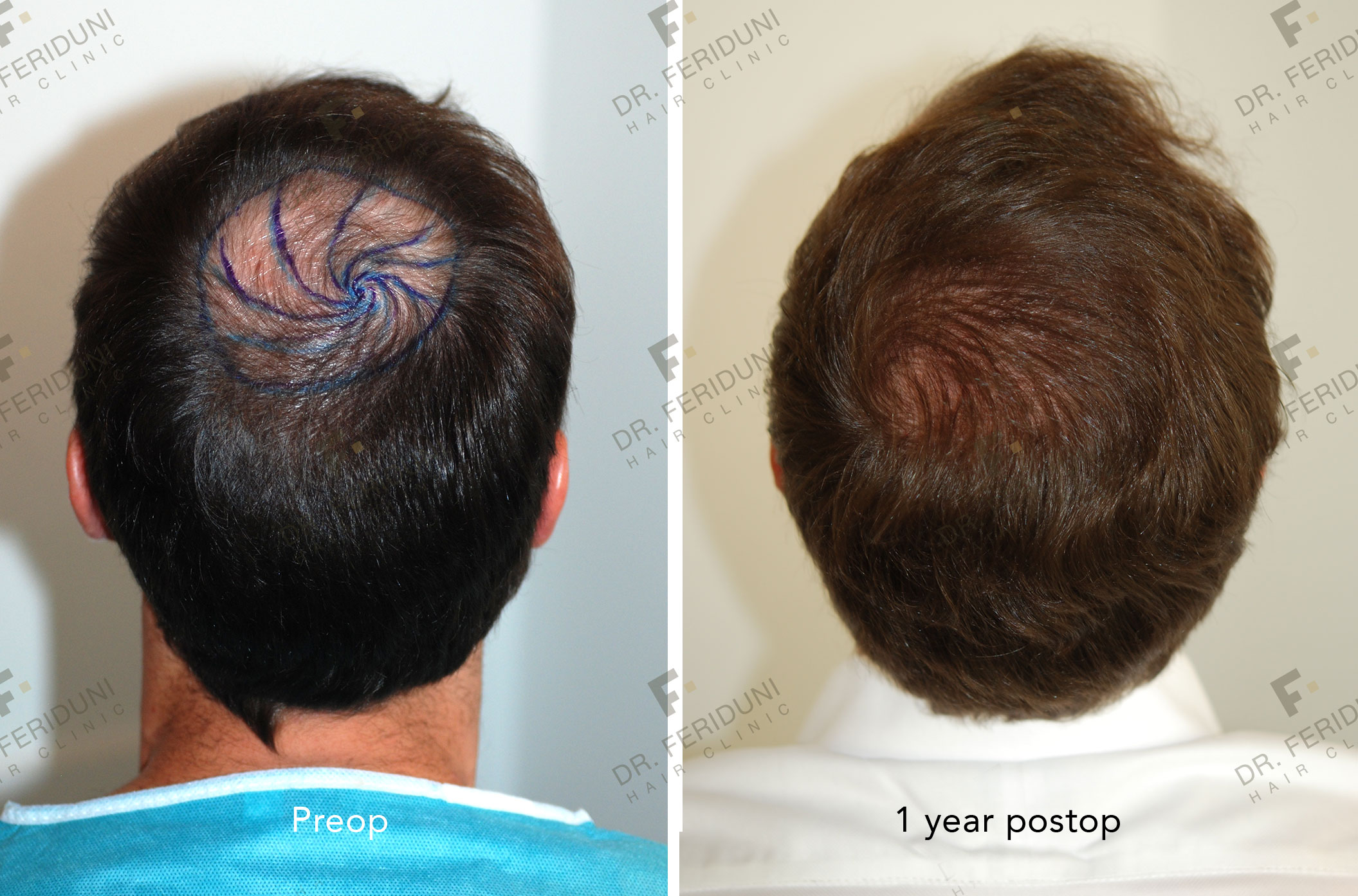 DS2 Trasplante de cabello - Dr. Feriduni