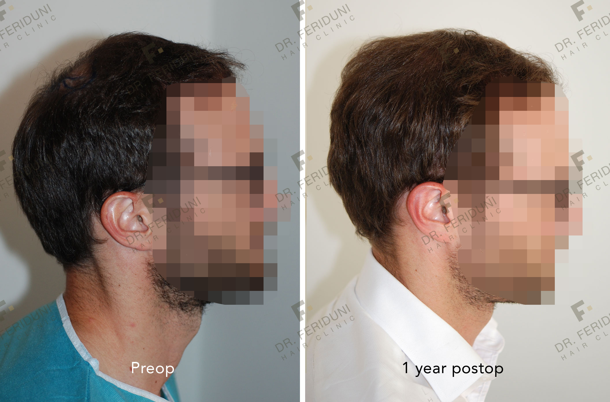 DS4 Trasplante de cabello - Dr. Feriduni