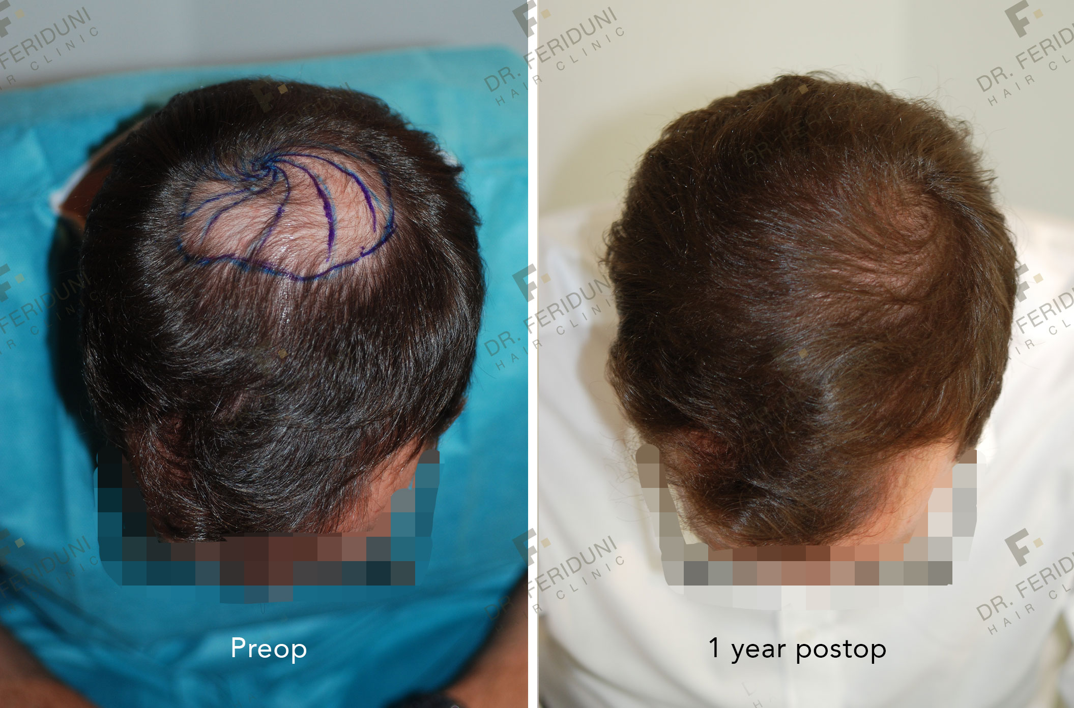 DS5 Trasplante de cabello - Dr. Feriduni