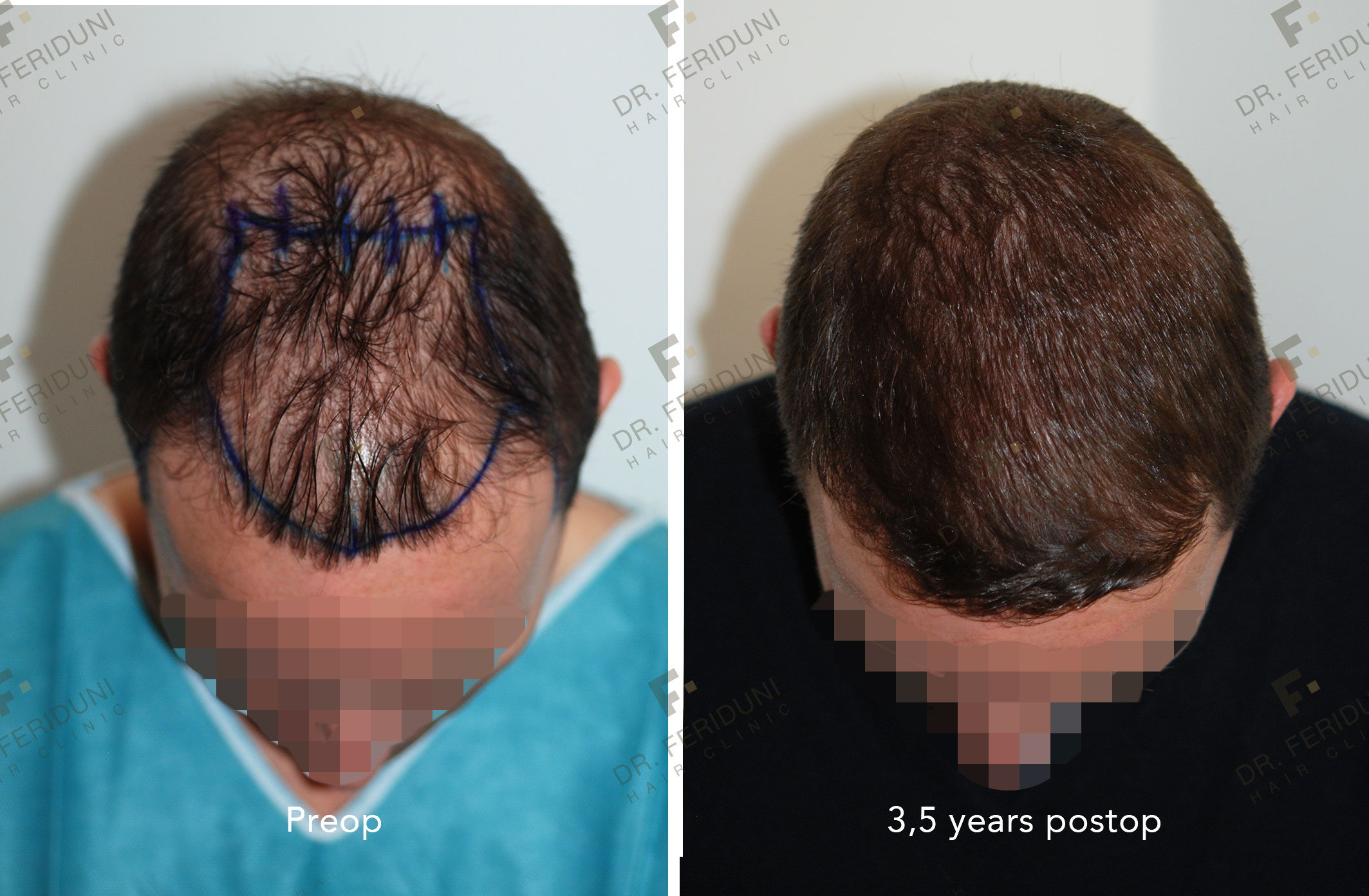 YP3 Haartransplantation - Dr. Feriduni
