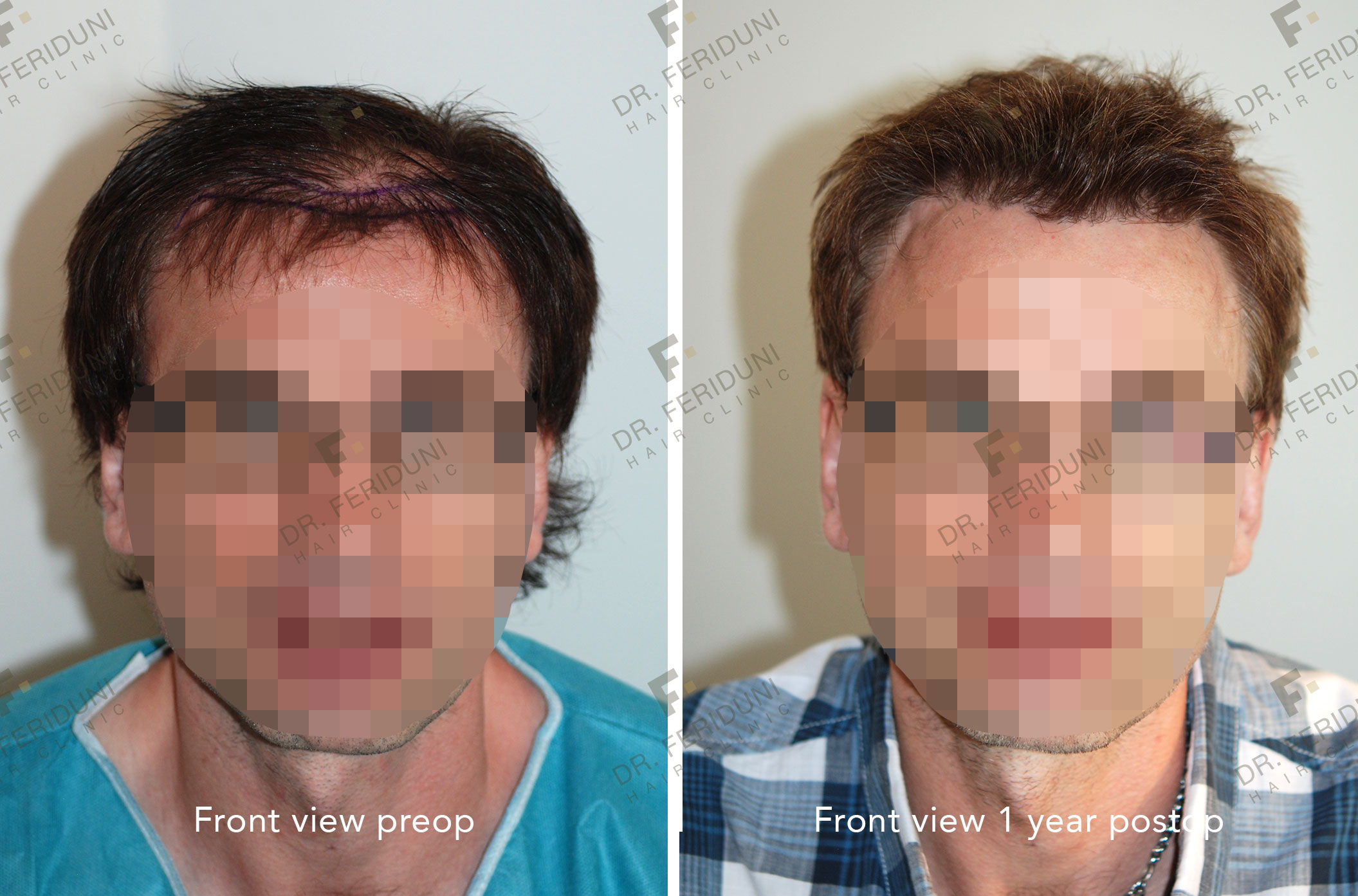 GK1 Haartransplantation - Dr. Feriduni