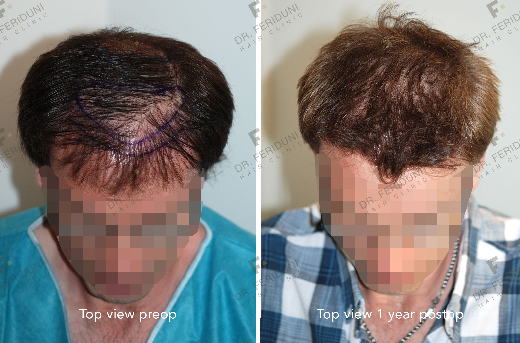 GK2 Haartransplantation - Dr. Feriduni