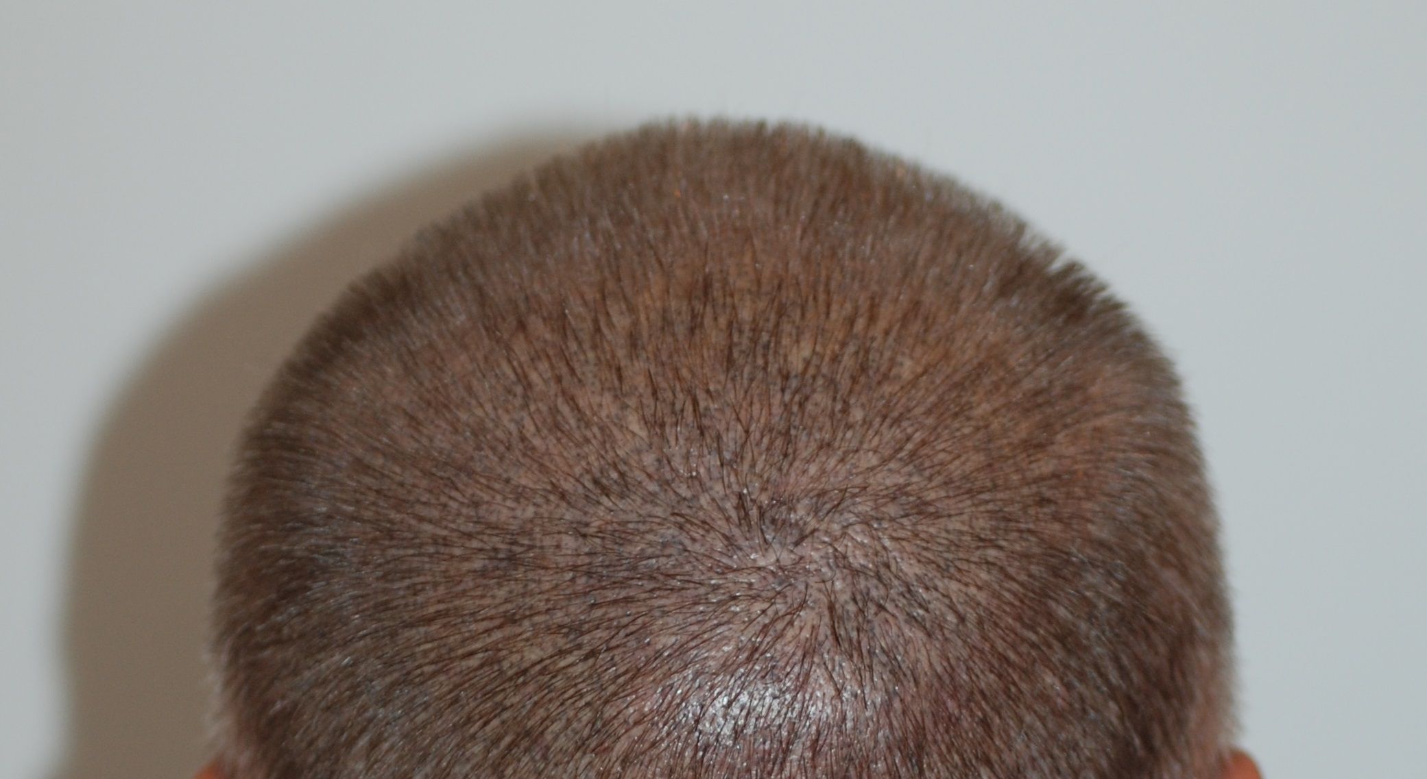 Trico Pigmentierung gegen Haarverlust