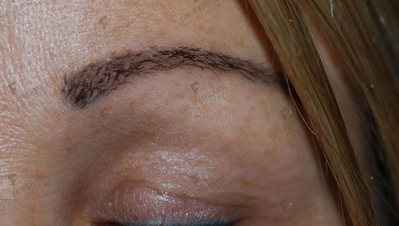Na3--398a5d16 Eyebrow transplantation - Dr. Feriduni