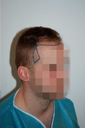 Male Pattern Baldness | Vegas Valley Hair Restoration