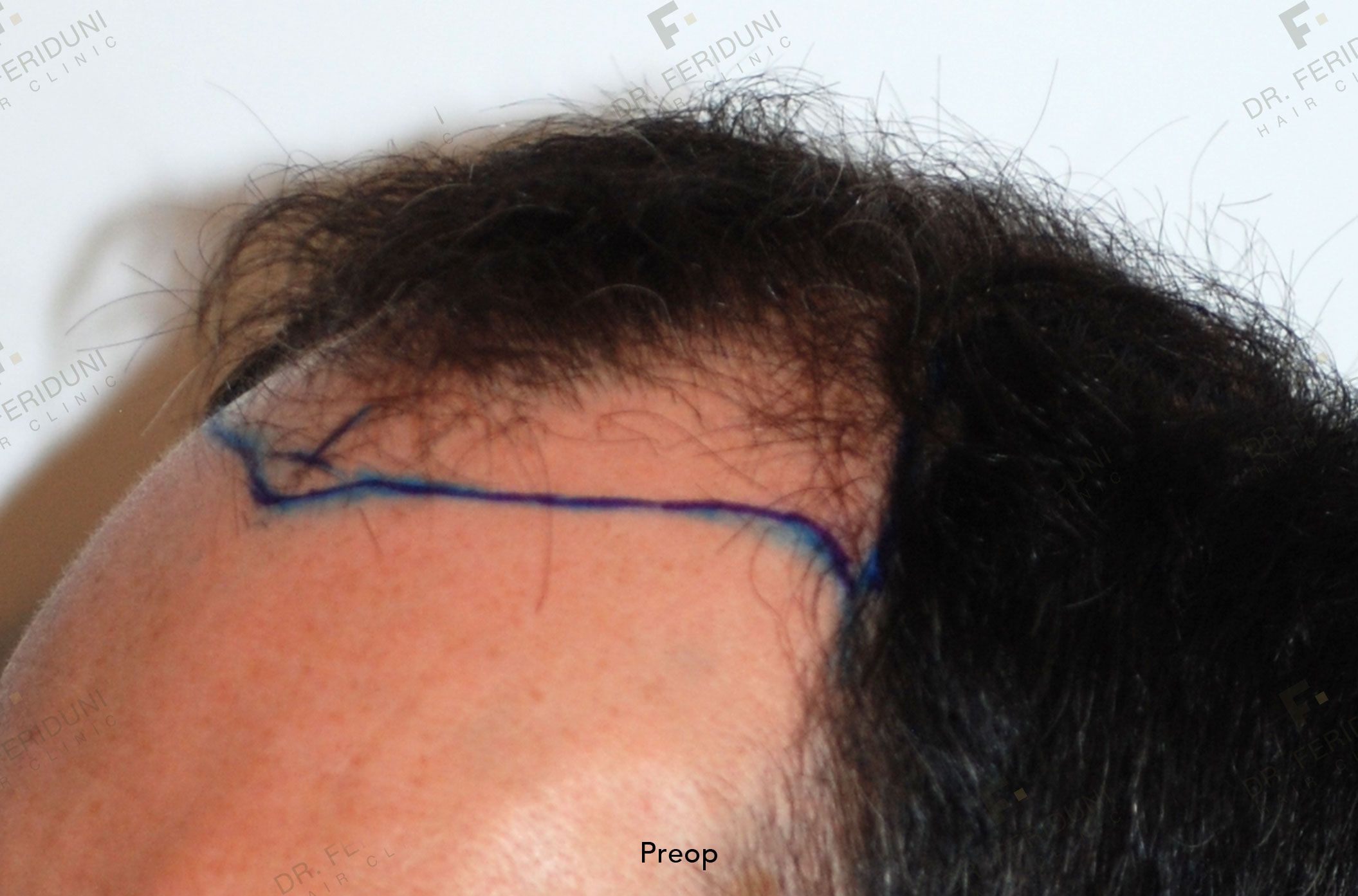 PO7-411c0813 Resultaten minor stage behandeling mannen - Dr. Feriduni