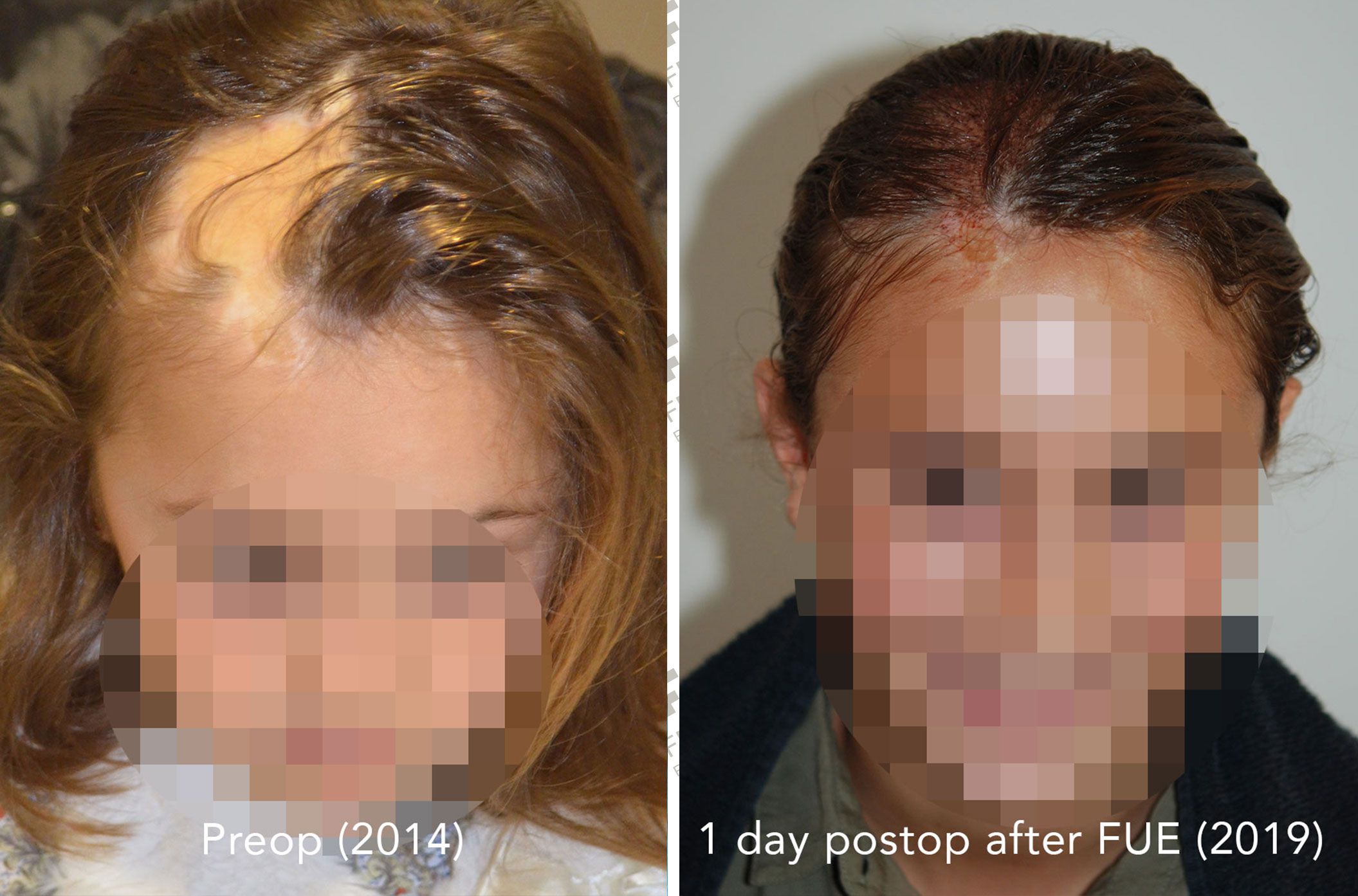 Fundacion-43c2d0c4 Risultati trapianto di capelli | Chirurgia invisibile - Dr. Feriduni