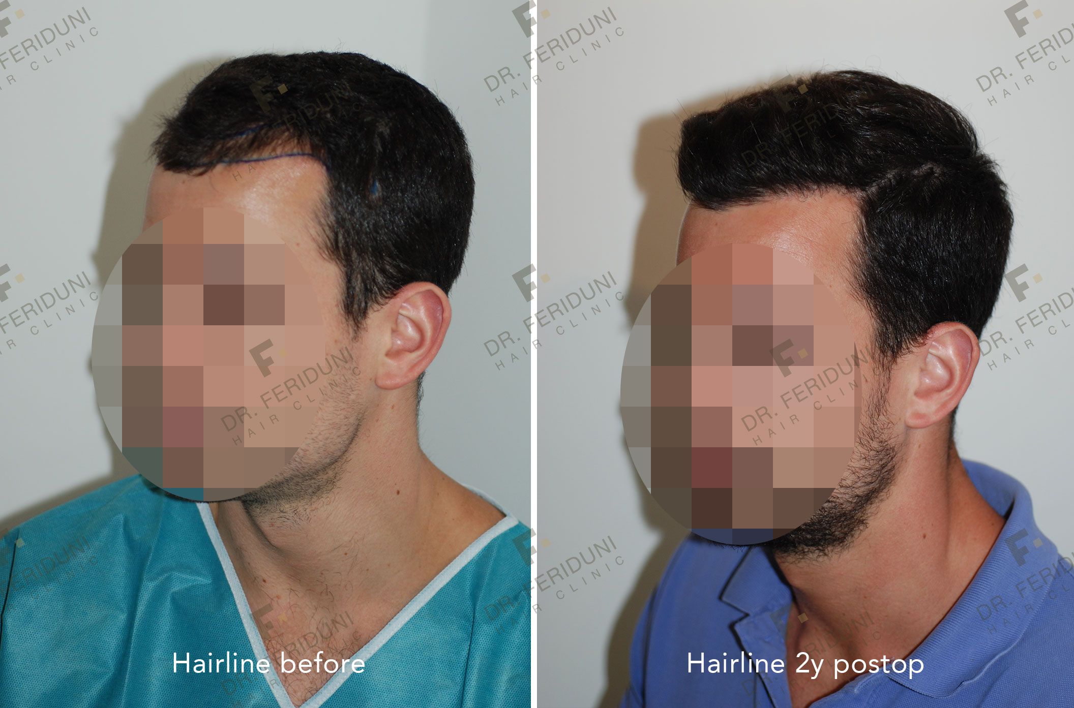 RM3-582d46a2 Natural hairline design - Dr. Feriduni
