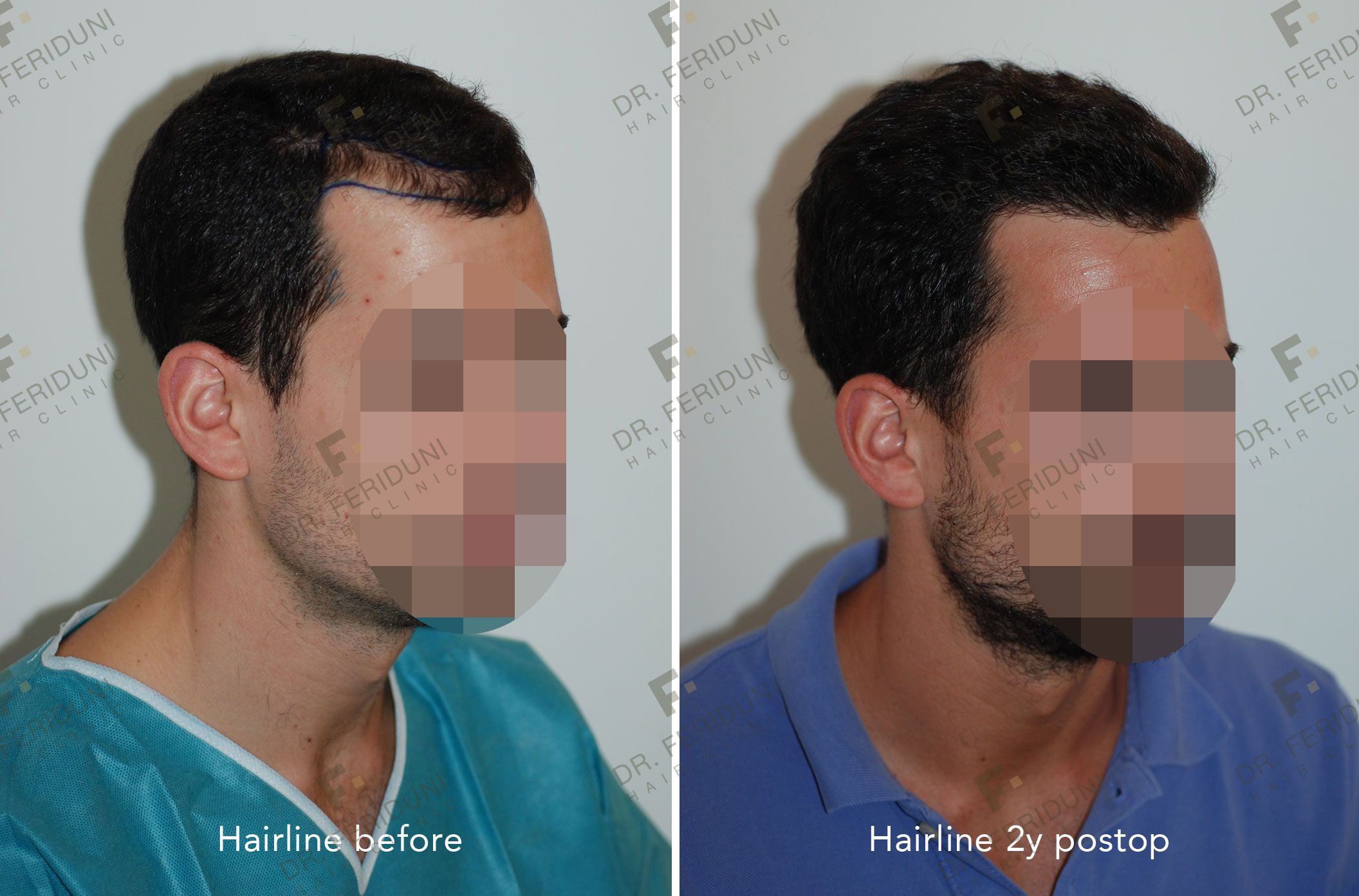 RM2-5998bbbf Natural hairline design - Dr. Feriduni