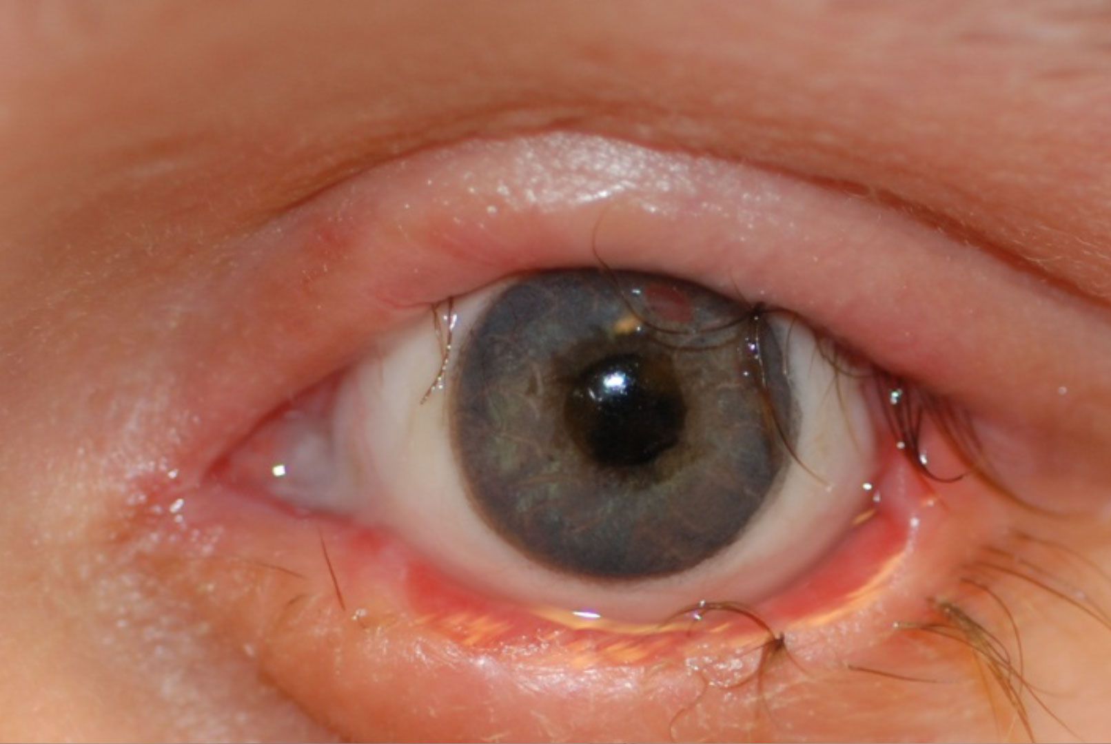 Eyelash-burn-62af6513 Wimperntransplantation - Dr. Feriduni