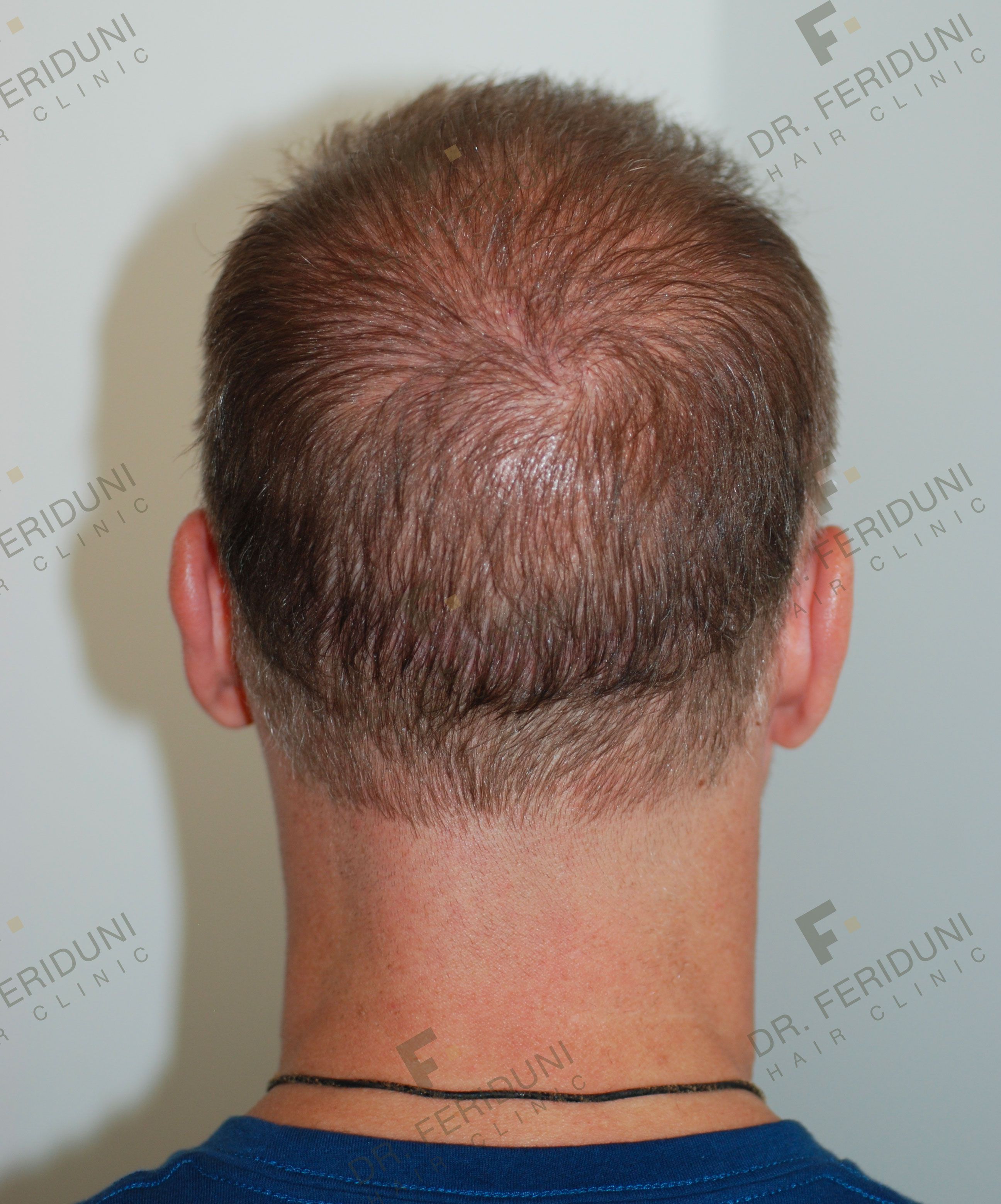 Trico-Pigmentierung und Haartransplantation