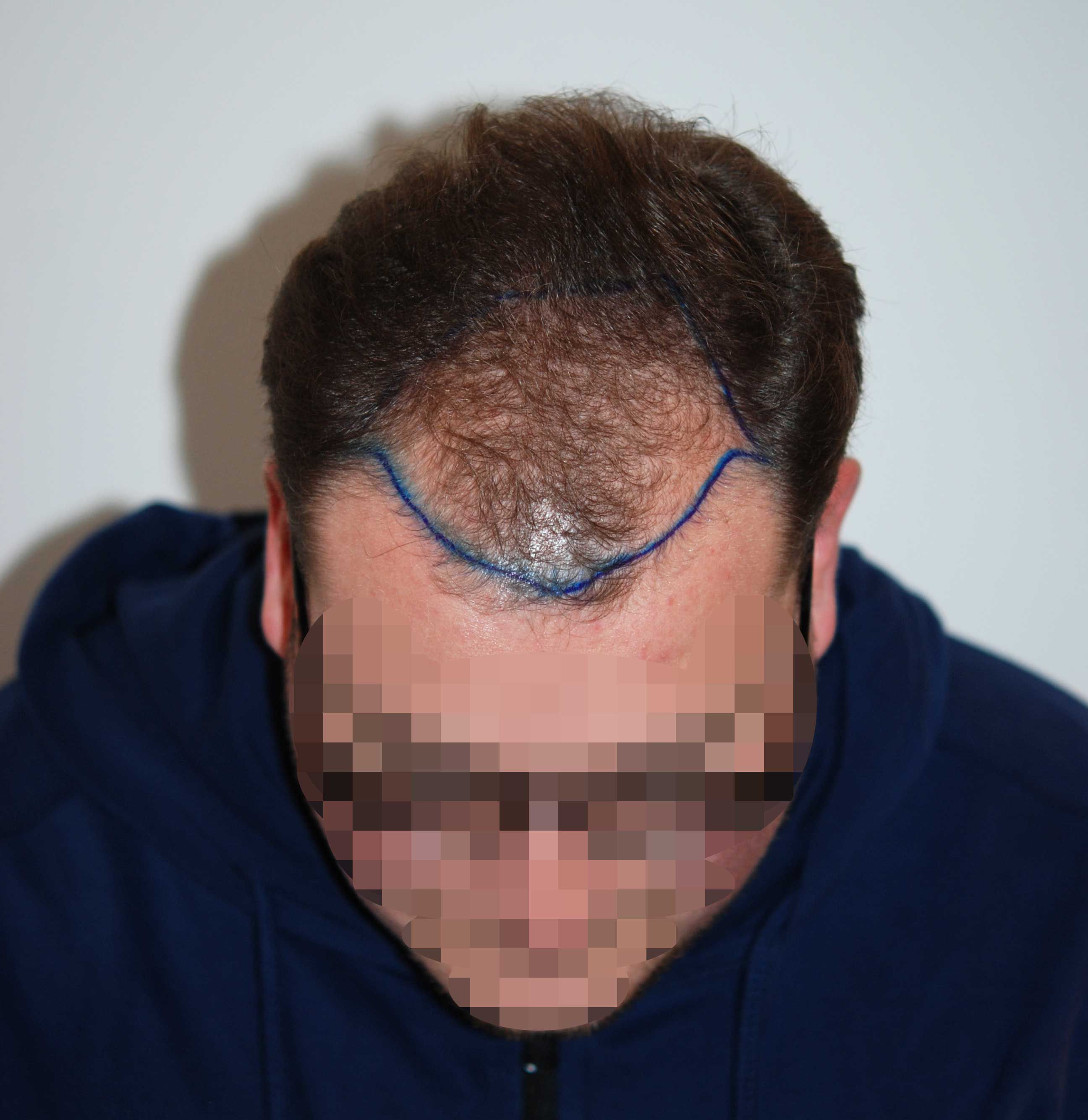 Ross-preop-topview-1-8aa00e19 Hair loss at a young age - Dr. Feriduni