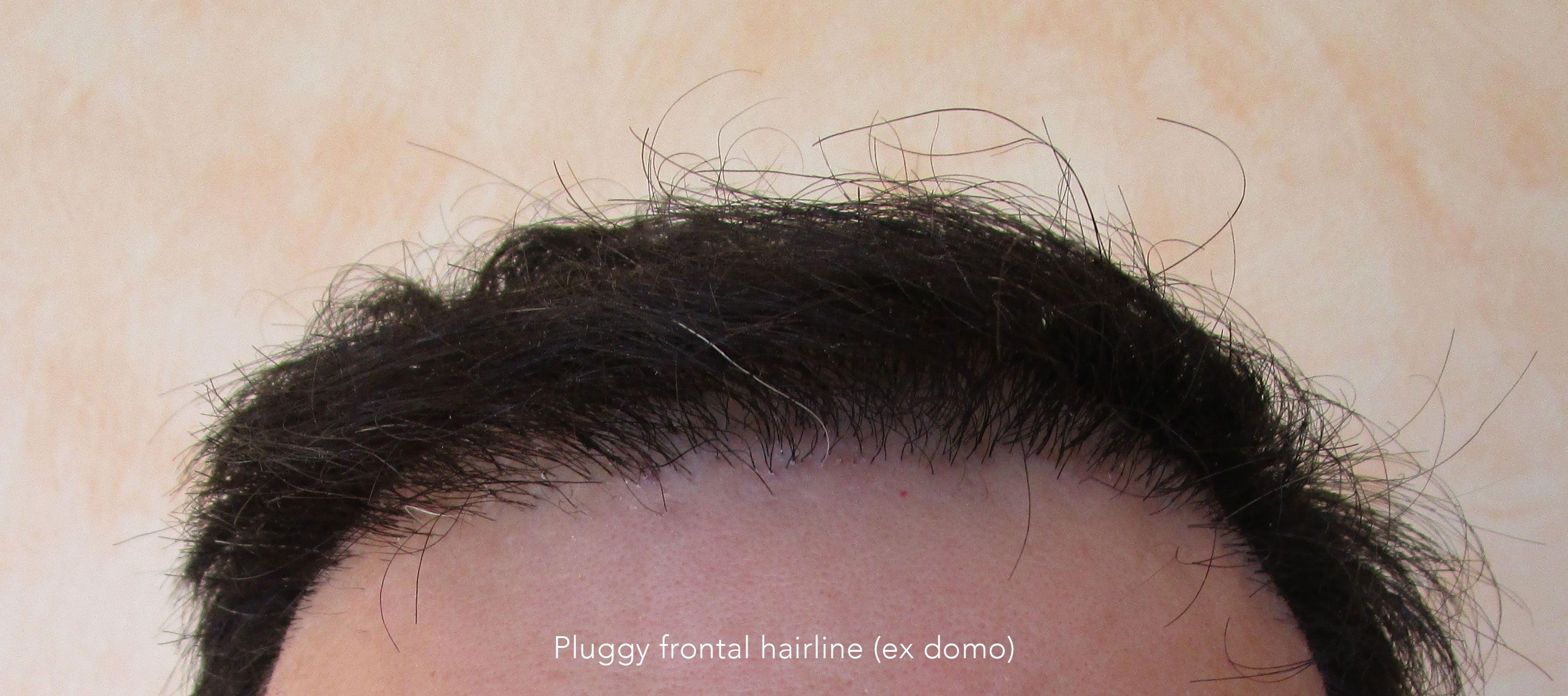 Preop1-hairline-a6d61a37 Repair - Dr. Feriduni