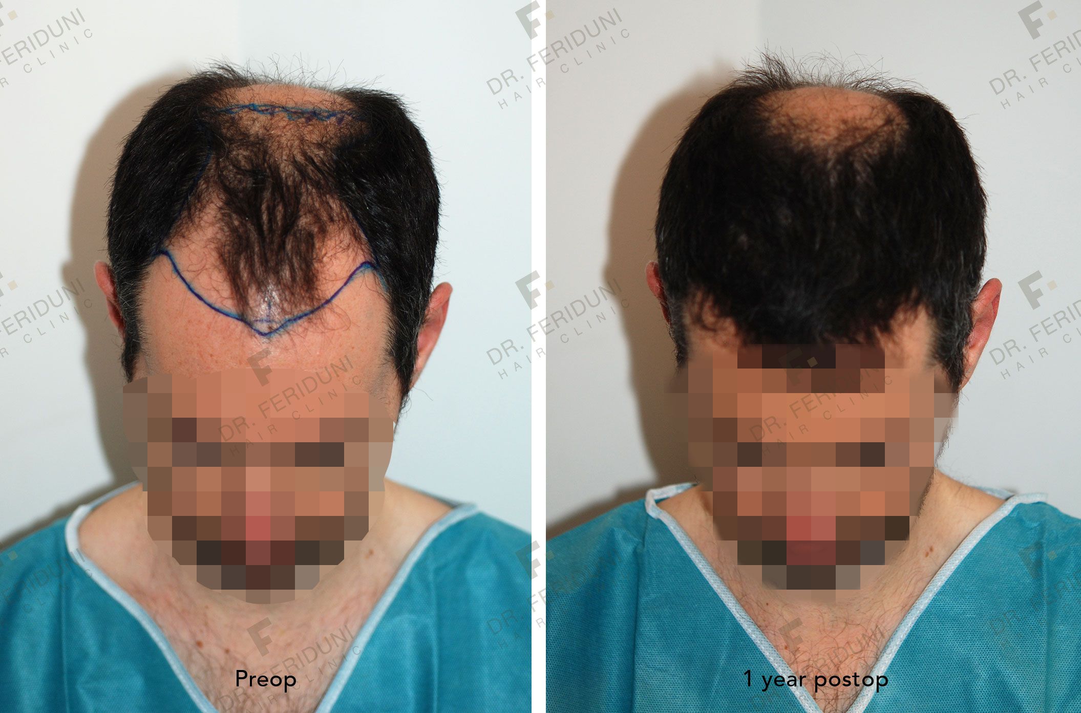 PO2--bac527b2 Natural hairline design - Dr. Feriduni