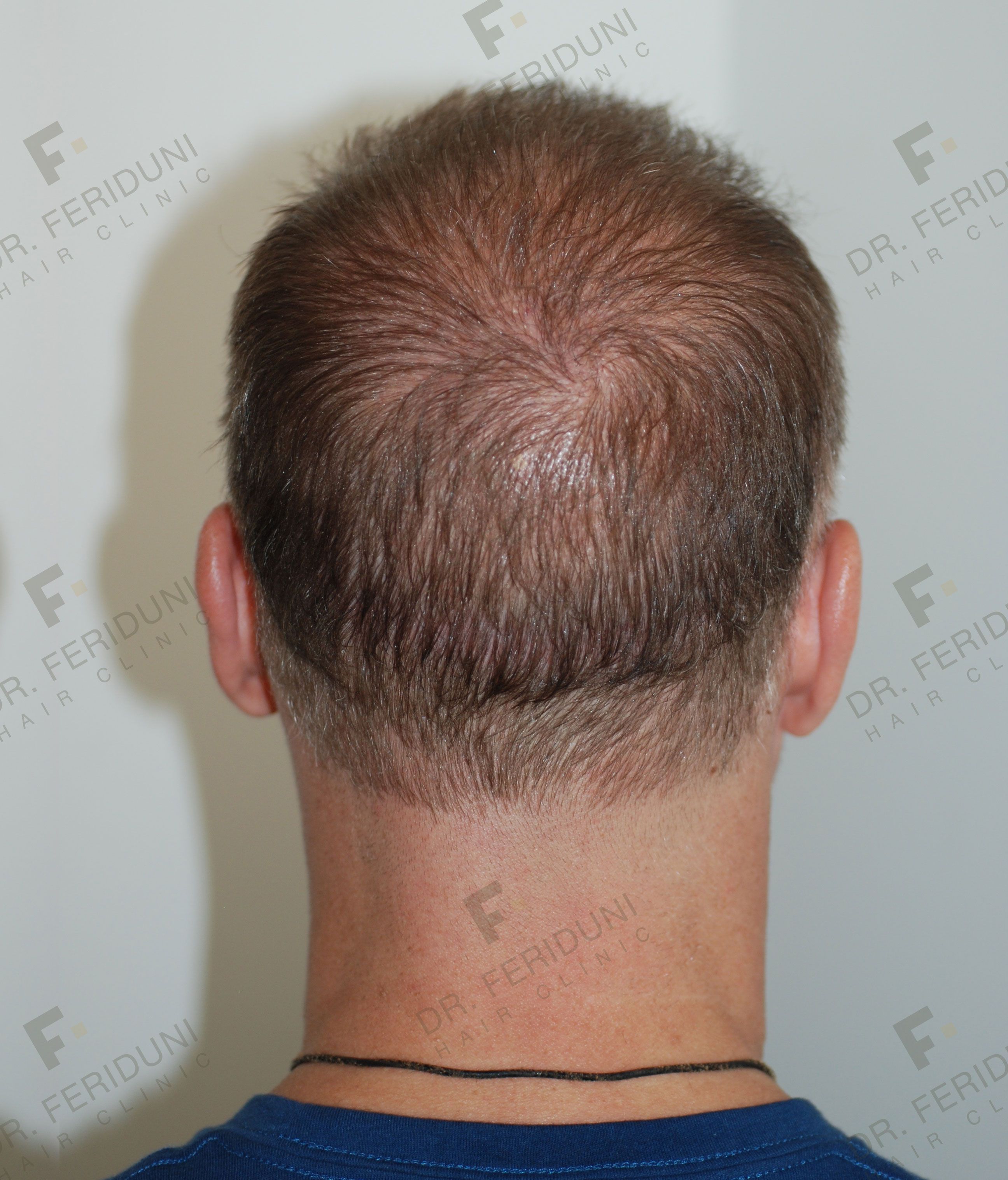 DSC_2969--bb052aad Risultato trattamento tricopigmentazione - Dr. Feriduni