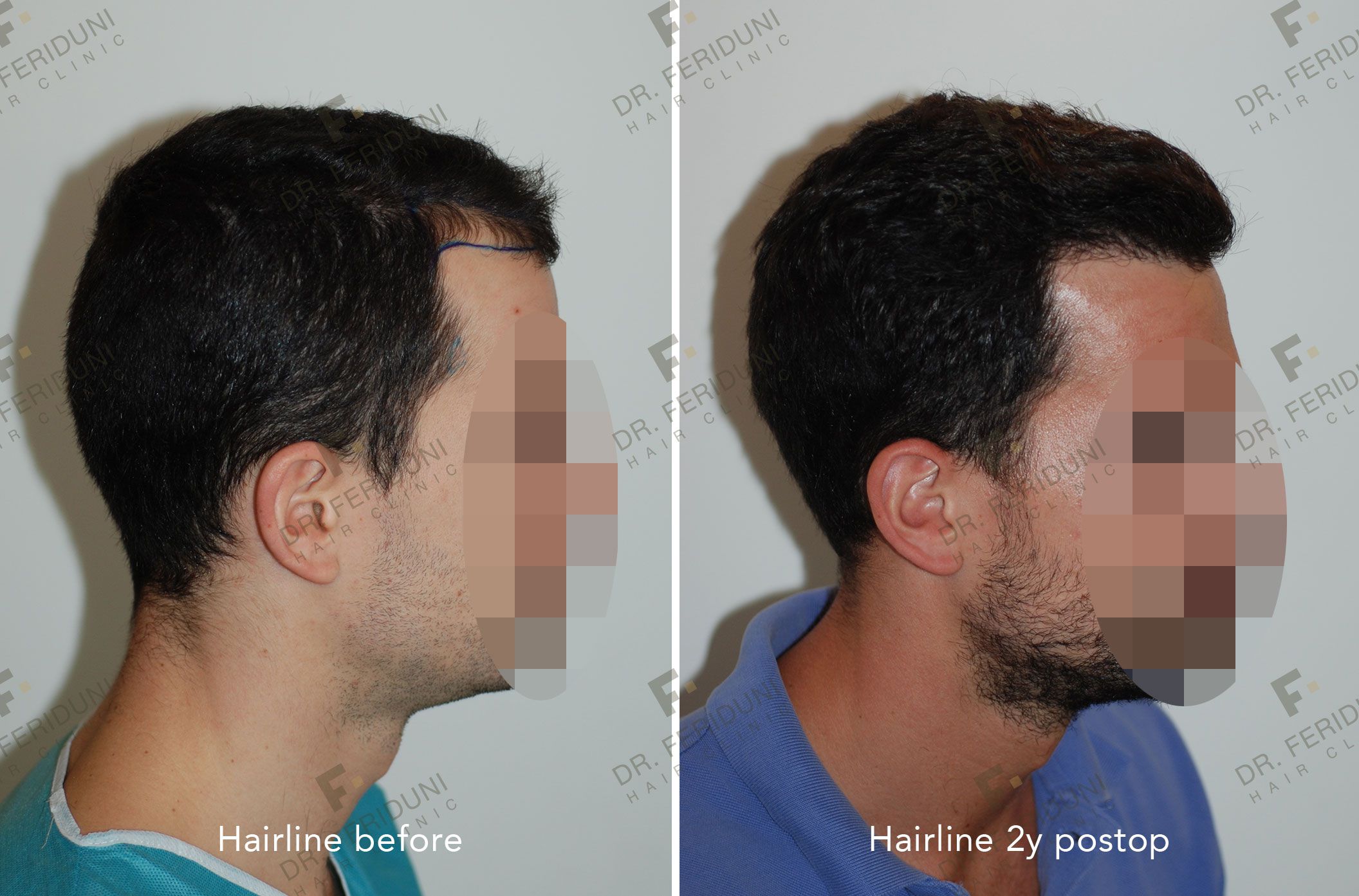 RM5-c4981956 Natural hairline design - Dr. Feriduni