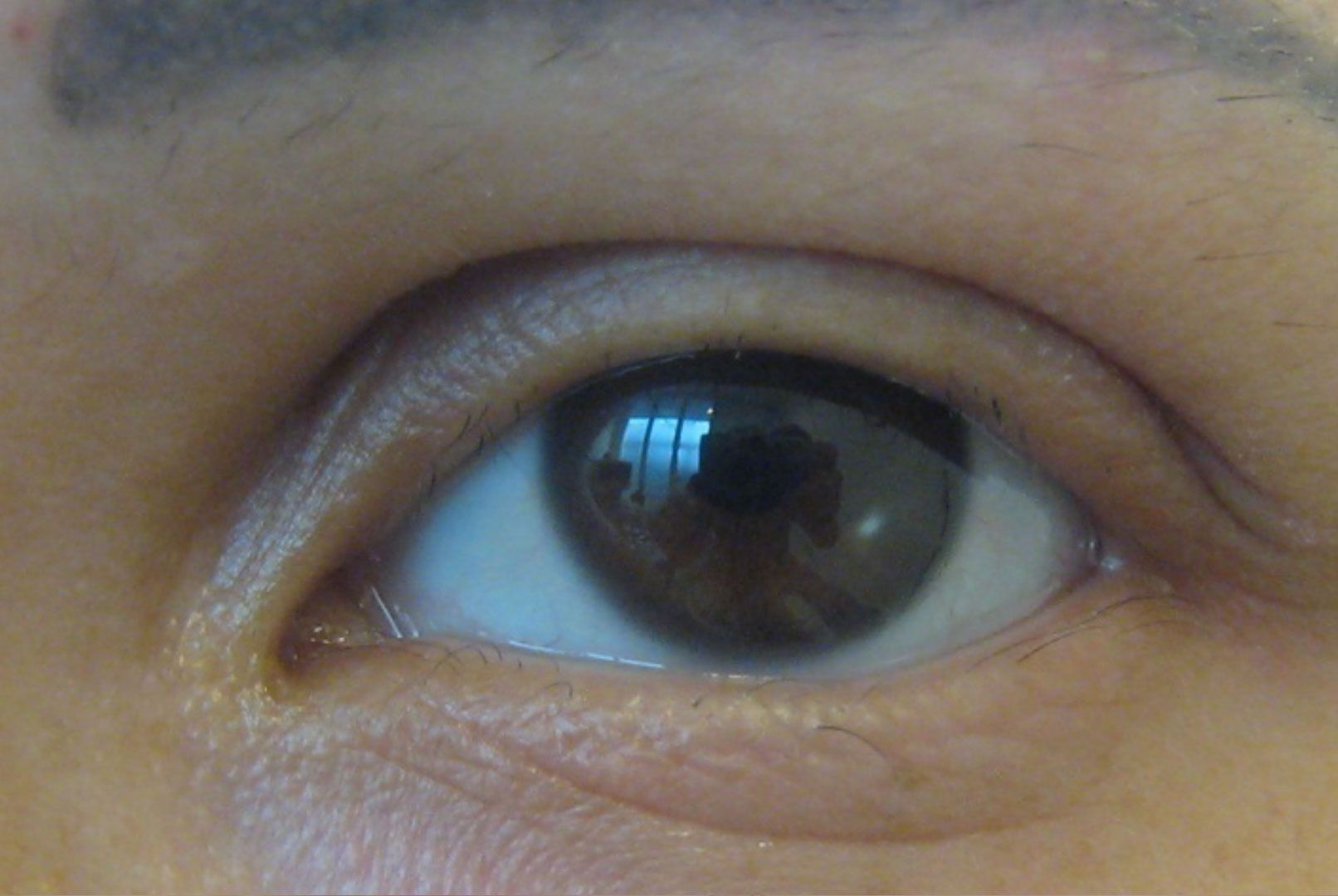 Eyelash-tricho-c6cecab2 Eyelash transplantation - Dr. Feriduni