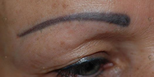 Voor2a-c7647809 Eyebrow transplantation - Dr. Feriduni