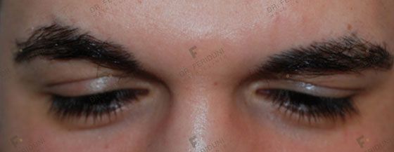 Na8-ccffb6d5 Eyebrow transplantation - Dr. Feriduni