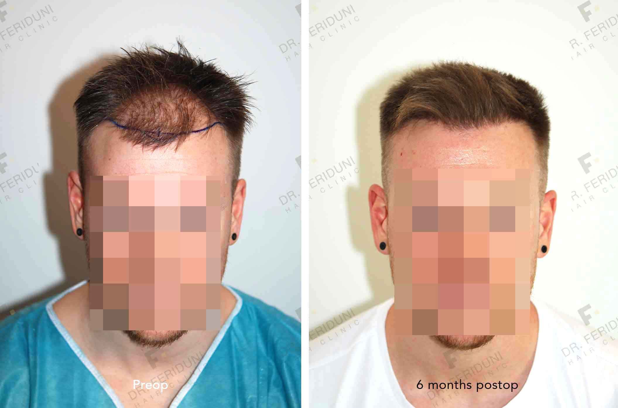 Results_men-d54bfc16 Dr. Feriduni - Specialista nel trapianto di capelli