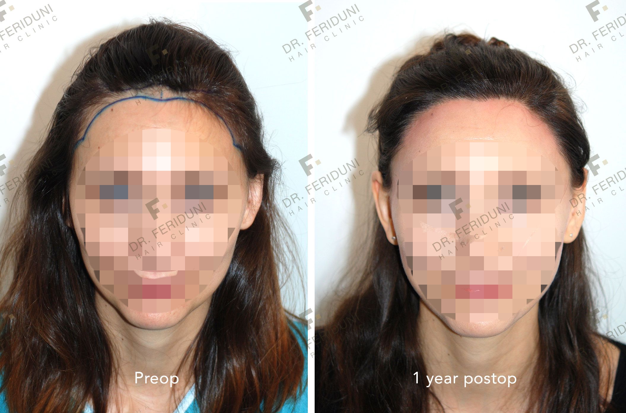 FC2-d8f1e38f Risultati trapianto di capelli | Chirurgia invisibile - Dr. Feriduni