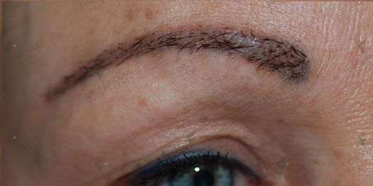 Na2a-efcdd210 Eyebrow transplantation - Dr. Feriduni
