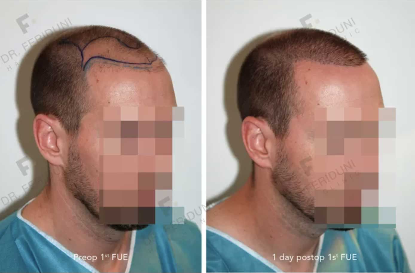 voor-en-na-Repair2-fde31eb9 Dr. Feriduni warns on increase repair hair transplants